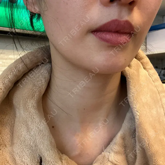 ピコレーザートーニング（美白・肝斑） ルラ美容クリニック 高田馬場院 BEFORE メイン用