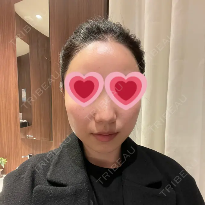 ハイフ（顔） メディアージュクリニック 青山院 BEFORE メイン用