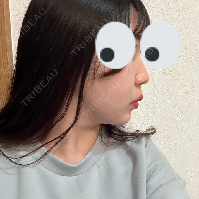 ヒアルロン酸注入（鼻） プライベートスキンクリニック 梅田本院 BEFORE メイン用