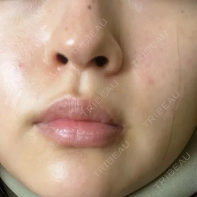 ピコレーザートーニング（美白・肝斑） ルラ美容クリニック 高田馬場院 BEFORE メイン用