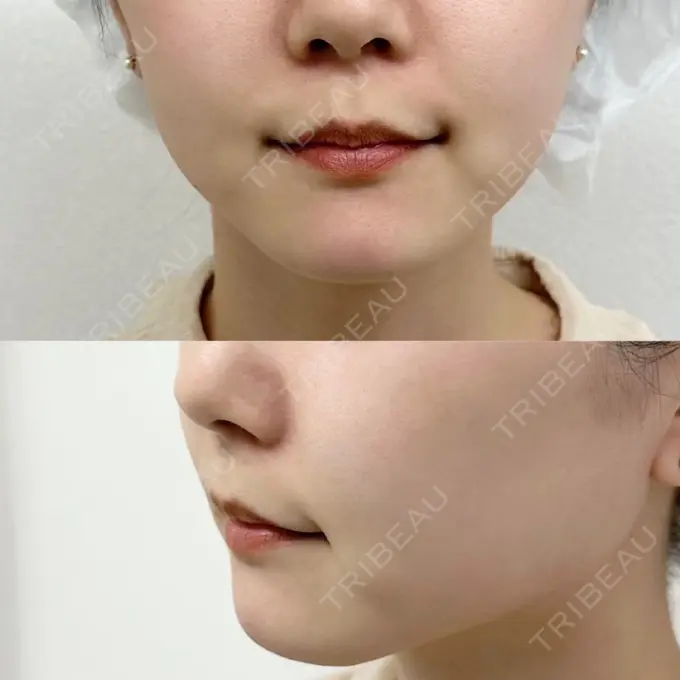 糸リフト / ヒアルロン酸注入（あご） ネビュラクリニック 広島院 BEFORE メイン用