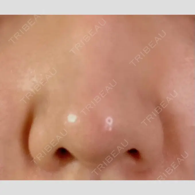 鼻孔縁挙上 シエルクリニック BEFORE メイン用