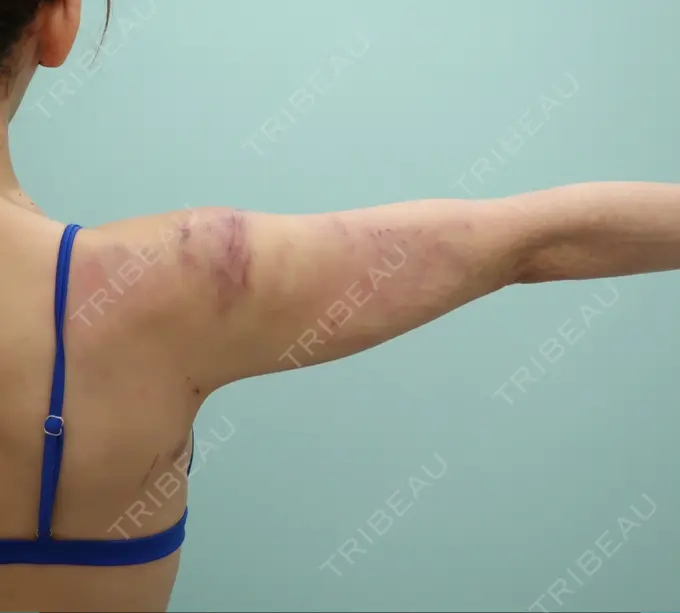 インディバ（二の腕） / インディバ（顔） WOM SALON【術後ケア取扱いサロン】 BEFORE メイン用