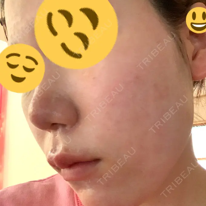 その他（肌） / ポテンツァ LOUIS CLINIC 二子玉川院【ルイクリニック】 BEFORE メイン用