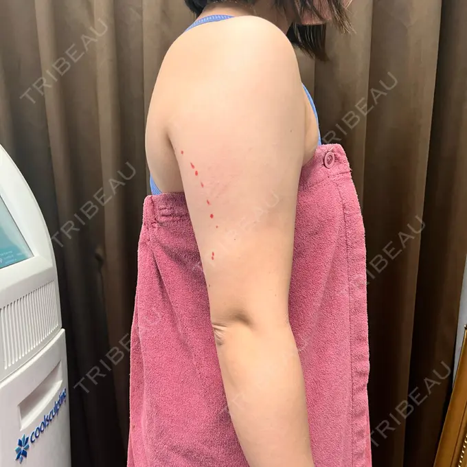 脂肪冷却（二の腕） KOSHOクリニック 本館 BEFORE メイン用