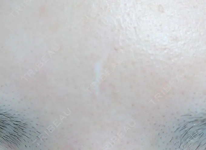 傷跡修正 / 傷跡修正 TETSU形成・美容クリニック BEFORE メイン用