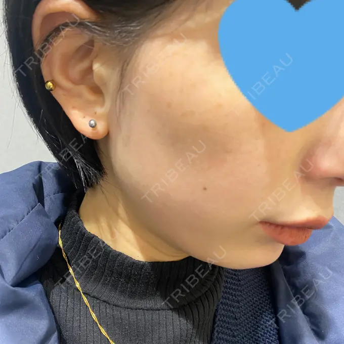 フォトRF Rosa Beauty Clinic BEFORE メイン用