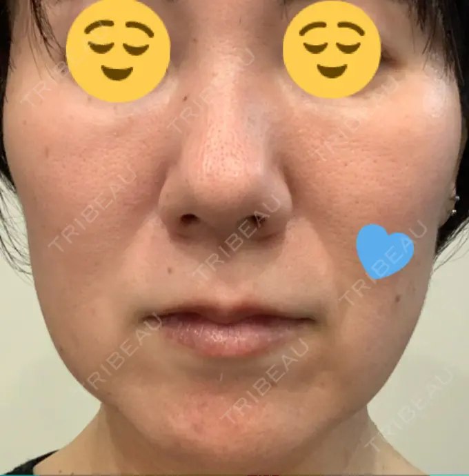 糸リフト 吉井クリニック BEFORE メイン用