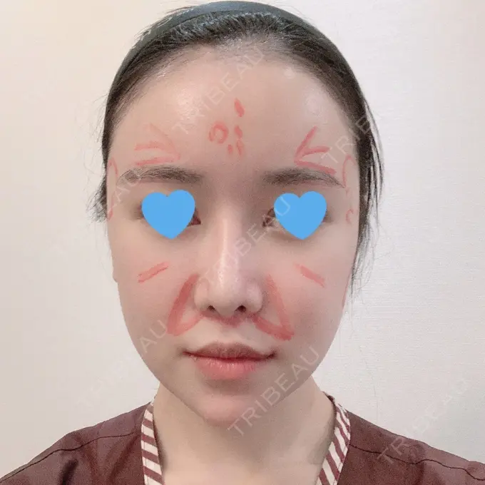 脂肪注入（肌） / 脂肪注入（額） / 脂肪注入（輪郭） スノウ（Snow）整形外科 BEFORE メイン用