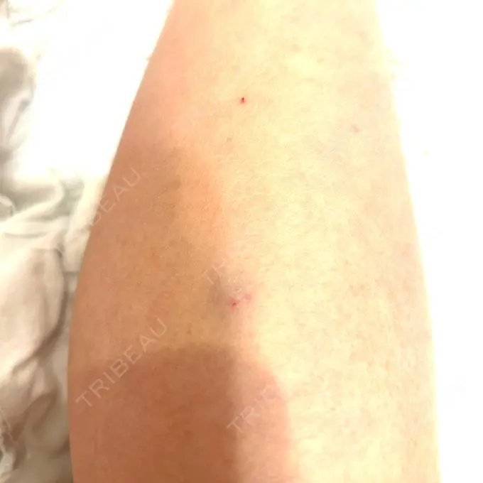 ボトックス（ふくらはぎ） LEAGRANT CLINIC 中目黒 BEFORE メイン用