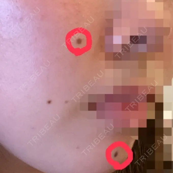 ほくろ・いぼ切除（肌） LIKI CLINIC KOBE BEFORE メイン用