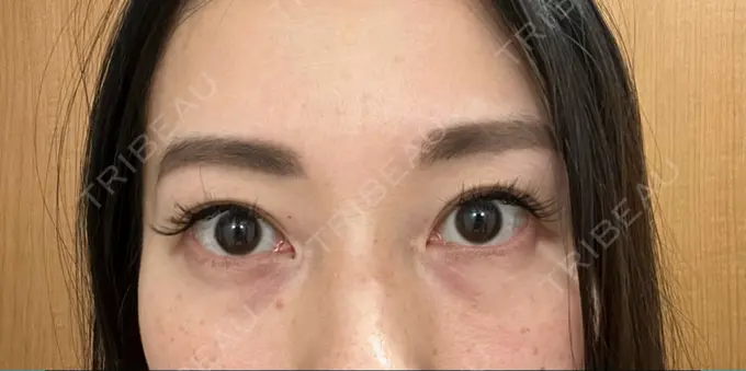 クマ治療 セオリークリニック BEFORE メイン用