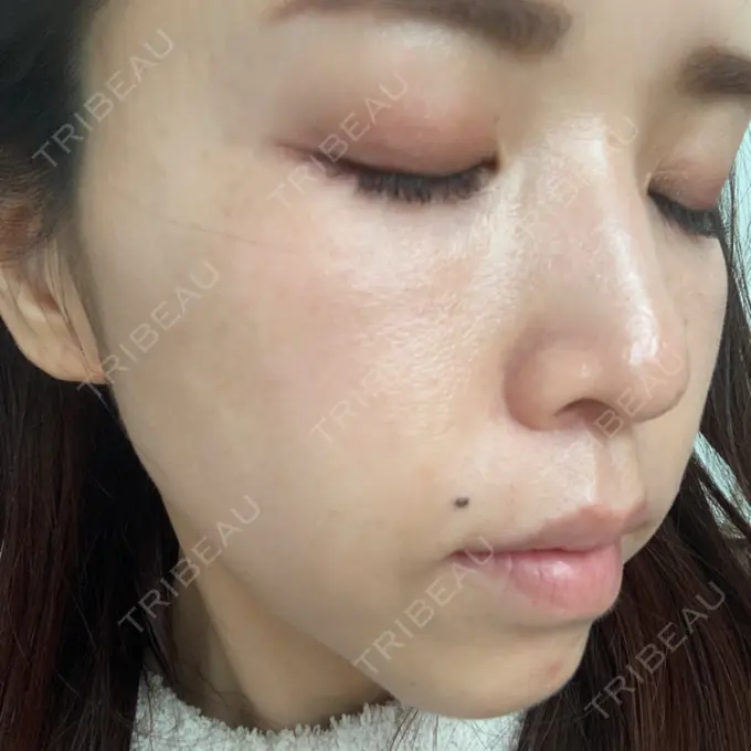 ニードルRF（ポテンツァなど） オラクル美容皮膚科 名古屋院 BEFORE メイン用