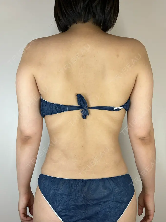 脂肪吸引（二の腕） GAYA body design clinic BEFORE メイン用