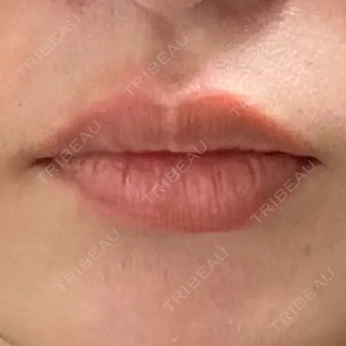 口角挙上 宇都宮竹内クリニック BEFORE メイン用