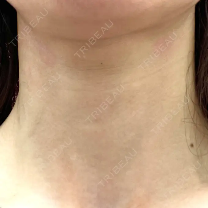 ヒアルロン酸注入（首） / PRP皮膚再生療法 ももスキンケアクリニック BEFORE メイン用