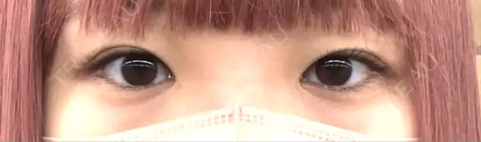 二重埋没 グランメドクリニック茨木 BEFORE メイン用