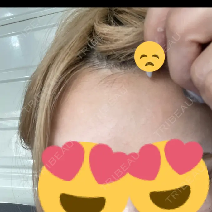 ボトックス（眉間） / ボトックス（目尻） / その他（目元） TCB東京中央美容外科 千葉駅前院 BEFORE メイン用