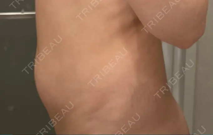 医療痩身（お腹） / 脂肪冷却（お腹） 吉祥寺アイビークリニック BEFORE メイン用