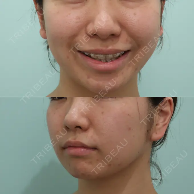 脂肪吸引（顔） / 下まぶたたるみ取り / メーラーファット除去 WOM CLINIC GINZA （ワム クリニック ギンザ） BEFORE メイン用