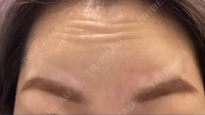 ボトックス（眉間） TCB東京中央美容外科 心斎橋院 BEFORE メイン用