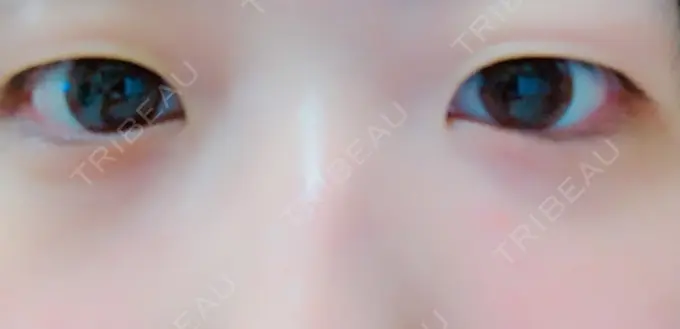 二重埋没 湘南美容クリニック 京都院 BEFORE メイン用