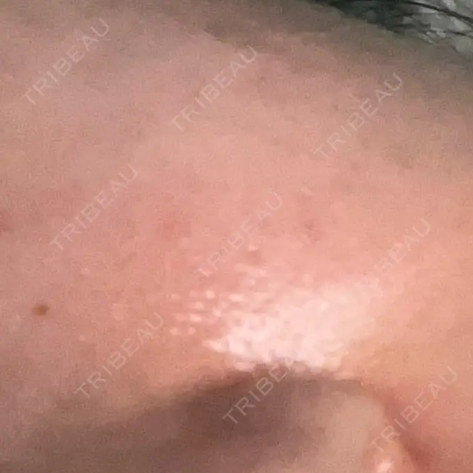 イオン導入 / 毛穴洗浄（ハイドラフェイシャルなど） / ポテンツァ A CLINIC（エークリニック） 横浜院 BEFORE メイン用