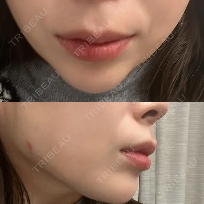 ボトックス（人中） Taide Suenaga Clinic（タイデスエナガクリニック） BEFORE メイン用