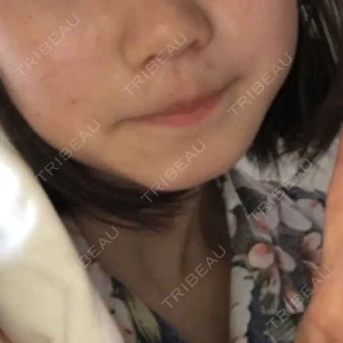 鼻尖形成（切開） / 小鼻縮小（切開） / 軟骨移植 / 鼻孔縁挙上 東京美容医療クリニック 池袋院 BEFORE メイン用