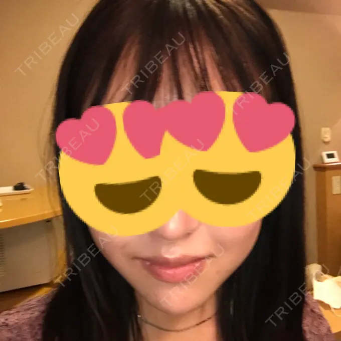 ヒアルロン酸注入（唇） / ボトックス（口角） オーマイクリニック【Oh My Clinic】 BEFORE メイン用