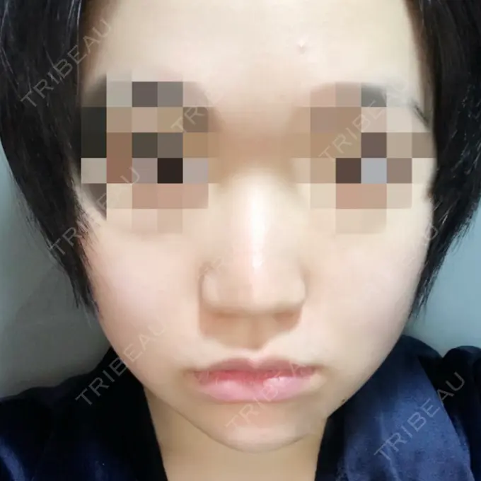 隆鼻術 / 鼻尖形成（切開） トップフェイス整形外科 BEFORE メイン用