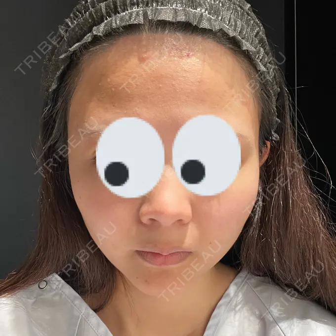 糸リフト / 脂肪吸引（顔） / 脂肪注入（額） X CLINIC 恵比寿院 BEFORE メイン用