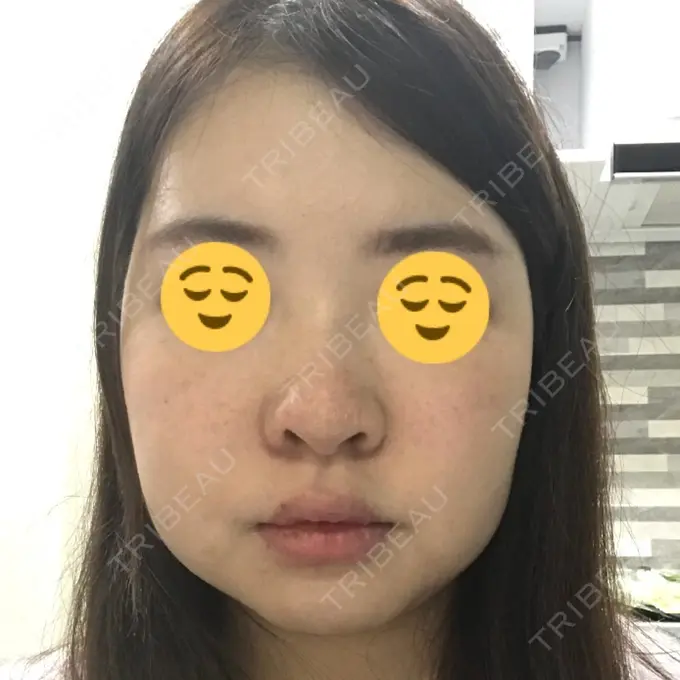 バッカルファット除去 / 脂肪吸引（顔） THE PLAN（ザ・プラン）美容整形外科・皮膚科 BEFORE メイン用