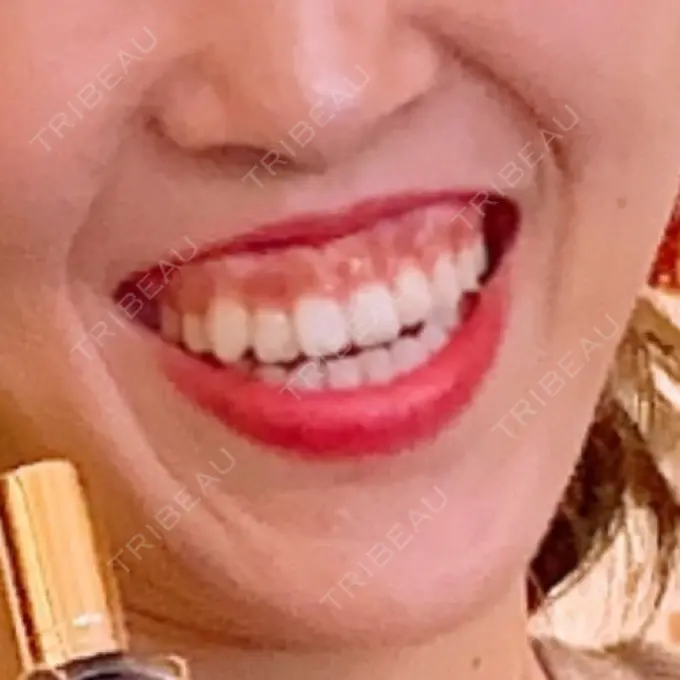 ボトックス（ガミースマイル） あいちビューティークリニック栄本院 BEFORE メイン用