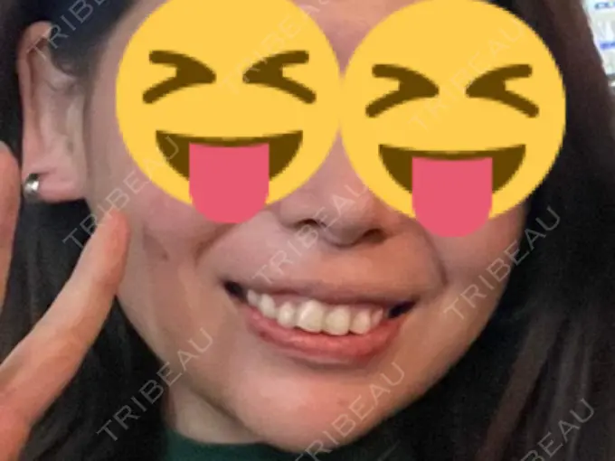 ホワイトニング 東京素肌クリニック 新宿院 BEFORE メイン用