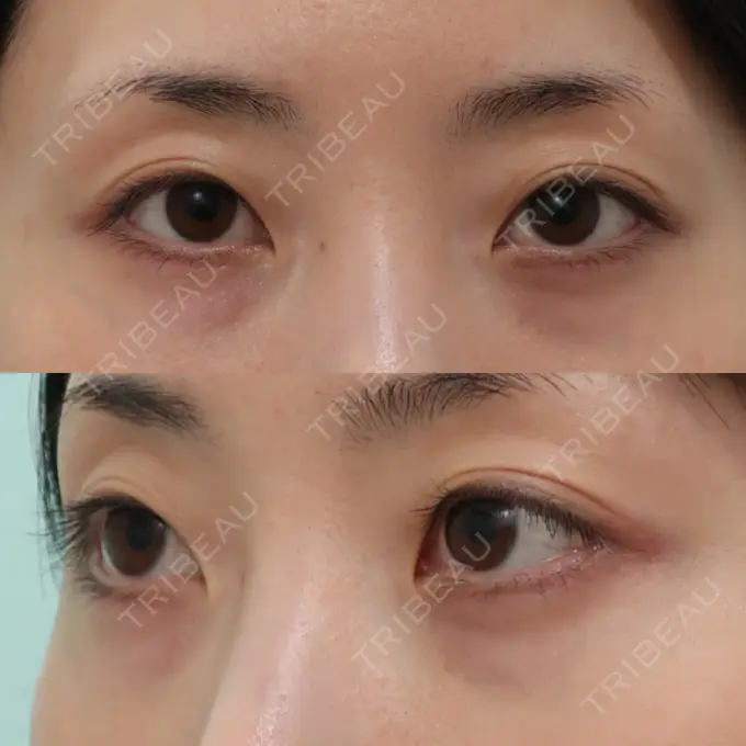 下まぶたの脂肪取り / 脂肪注入（目の下） WOM CLINIC GINZA （ワム クリニック ギンザ） BEFORE メイン用