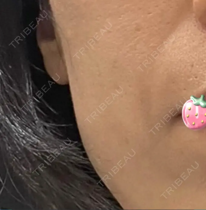 脂肪注入（肌） 湘南美容クリニック 秋葉原院 BEFORE メイン用