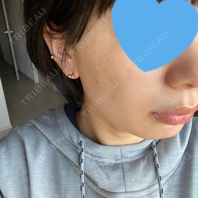 ピコレーザートーニング（美白・肝斑） ルラ美容クリニック 名古屋本院 BEFORE メイン用