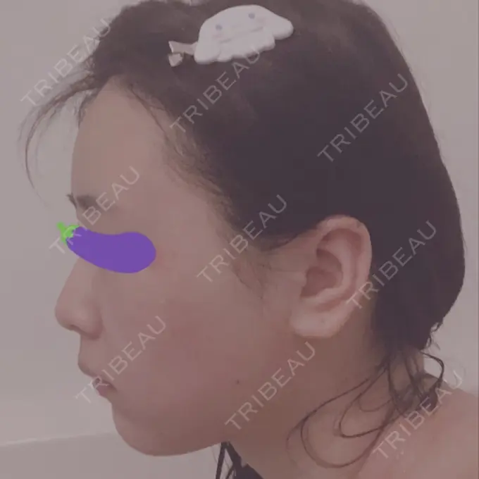 バッカルファット除去 / 脂肪吸引（顔） / ヒアルロン酸注入（鼻） / ボトックス（あご） / 水光注射（ハリ・美肌） / ボトックス（エラ・小顔） / ボトックス（口角） / 白玉点滴・注射 エートップ美容整形外科 BEFORE メイン用