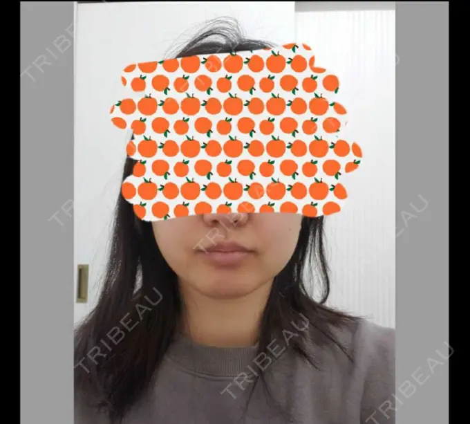 ボトックス（エラ・小顔） TCB東京中央美容外科 自由が丘院 BEFORE メイン用