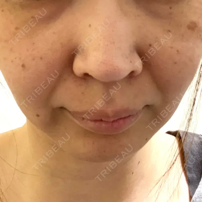 ピコスポット X CLINIC 大阪院 BEFORE メイン用