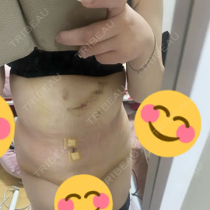 脂肪吸引（お腹） ガーデンクリニック 名古屋院 BEFORE メイン用