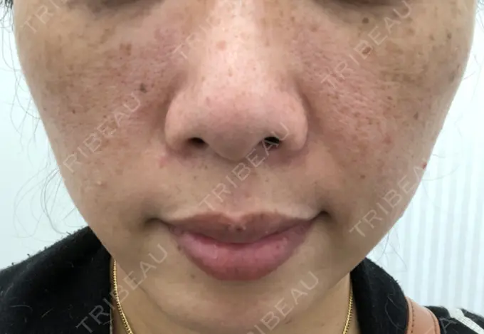 ボトックス（あご） / ボトックス（エラ・小顔） / ボトックス（目尻） TCB東京中央美容外科 新宿三丁目院 BEFORE メイン用