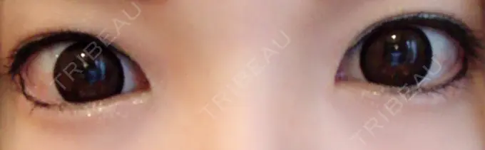 ヒアルロン酸注入（涙袋） しのぶ皮膚科 BEFORE メイン用