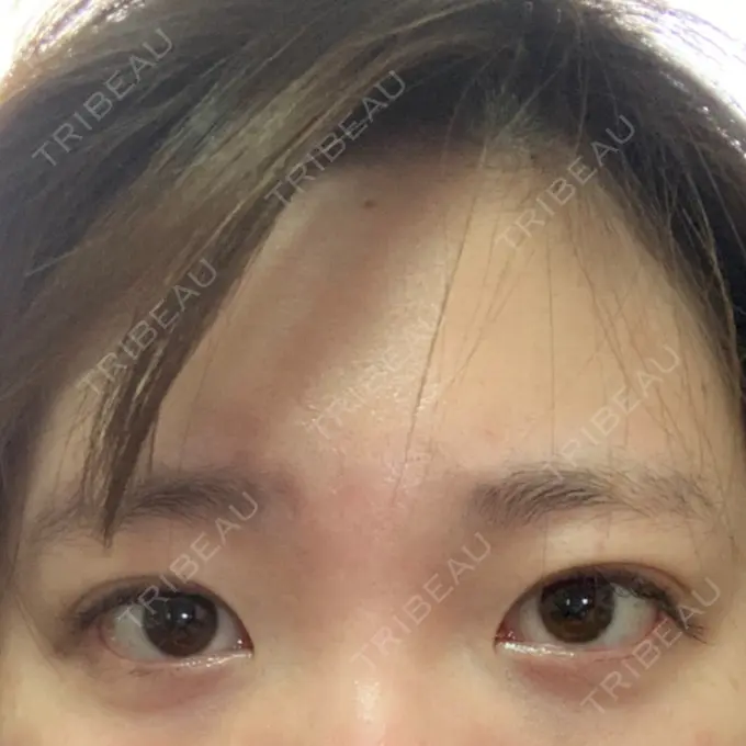 二重埋没 グランメドクリニック茨木 BEFORE メイン用