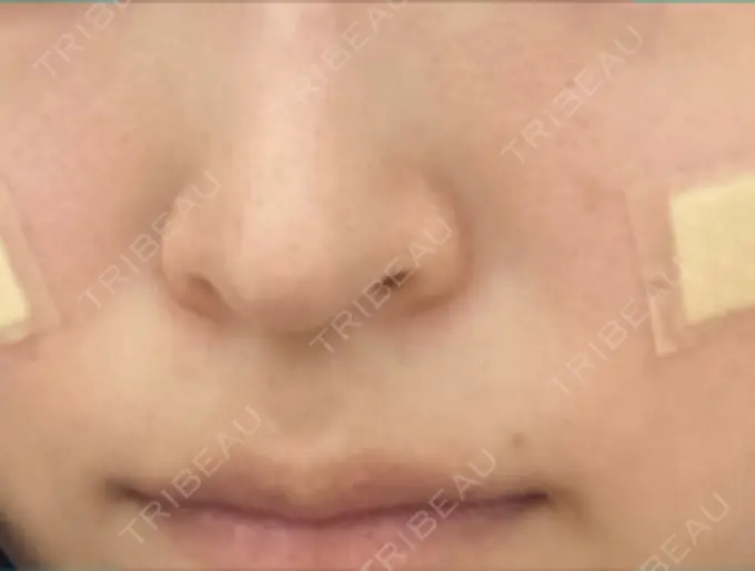 その他（鼻） ルラ美容クリニック 名古屋本院 BEFORE メイン用