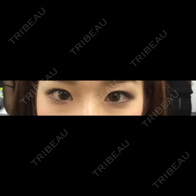 二重埋没 / 上まぶたの脂肪取り TCB東京中央美容外科 仙台駅前院 BEFORE メイン用