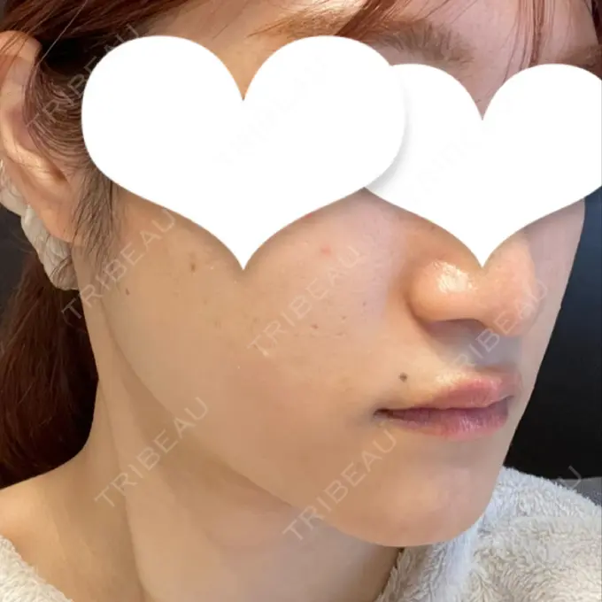 ボトックス（エラ・小顔） LOUIS CLINIC 二子玉川院【ルイクリニック】 BEFORE メイン用