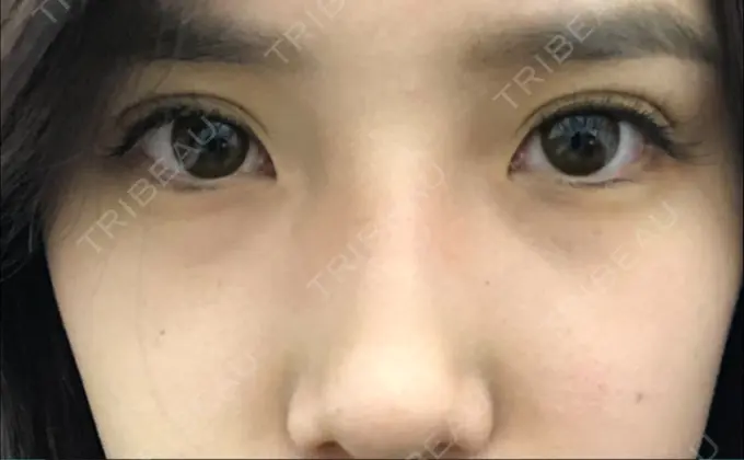 ヒアルロン酸注入（涙袋） / ヒアルロン酸注入（鼻） TCB東京中央美容外科 中野院 BEFORE メイン用