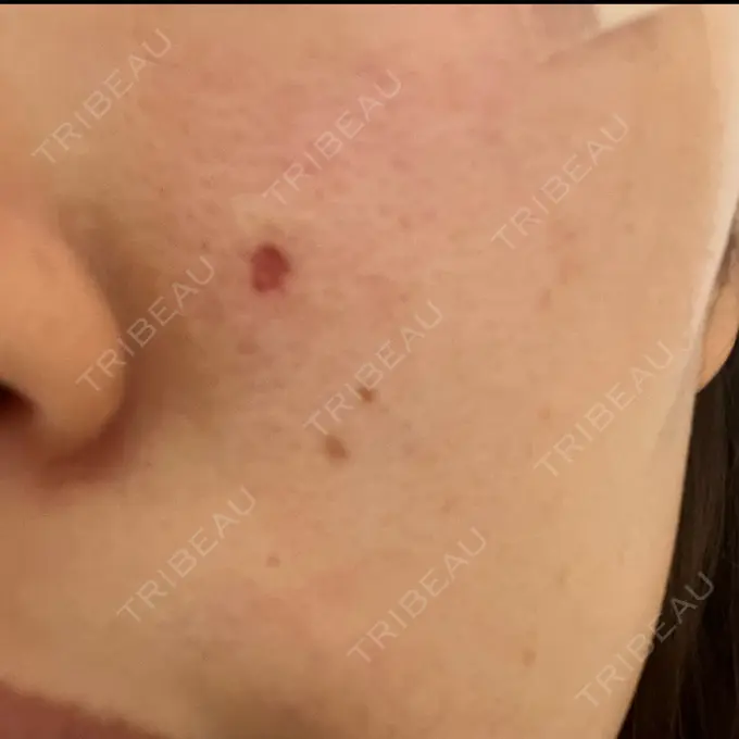 ほくろ・いぼ除去レーザー（肌） / シミ取りレーザー アイ&スキンクリニック東京ソラマチ BEFORE メイン用